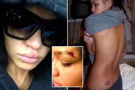 New photo wey shock people show Cassie Ventura injury from wetin her ex-boyfriend Diddy do her